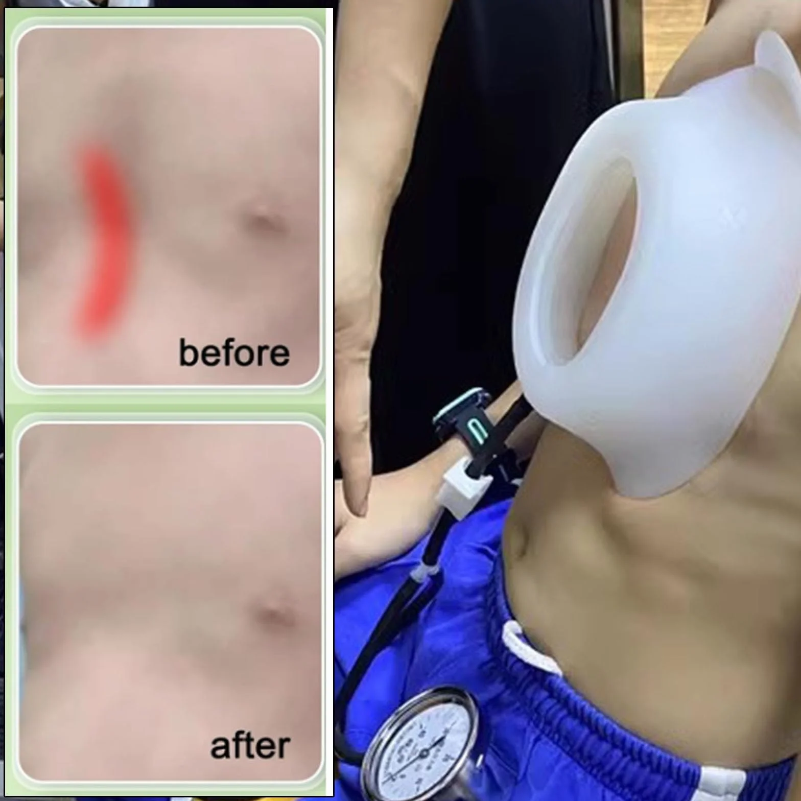 Pectus Excavatum Bańka próżniowa – Pectus Excavatum Orteza ortezy dla dorosłych i dzieci, fizyczna korekcja Pectus Excavatum, terapia bąbelkami próżniowymi (L-L)