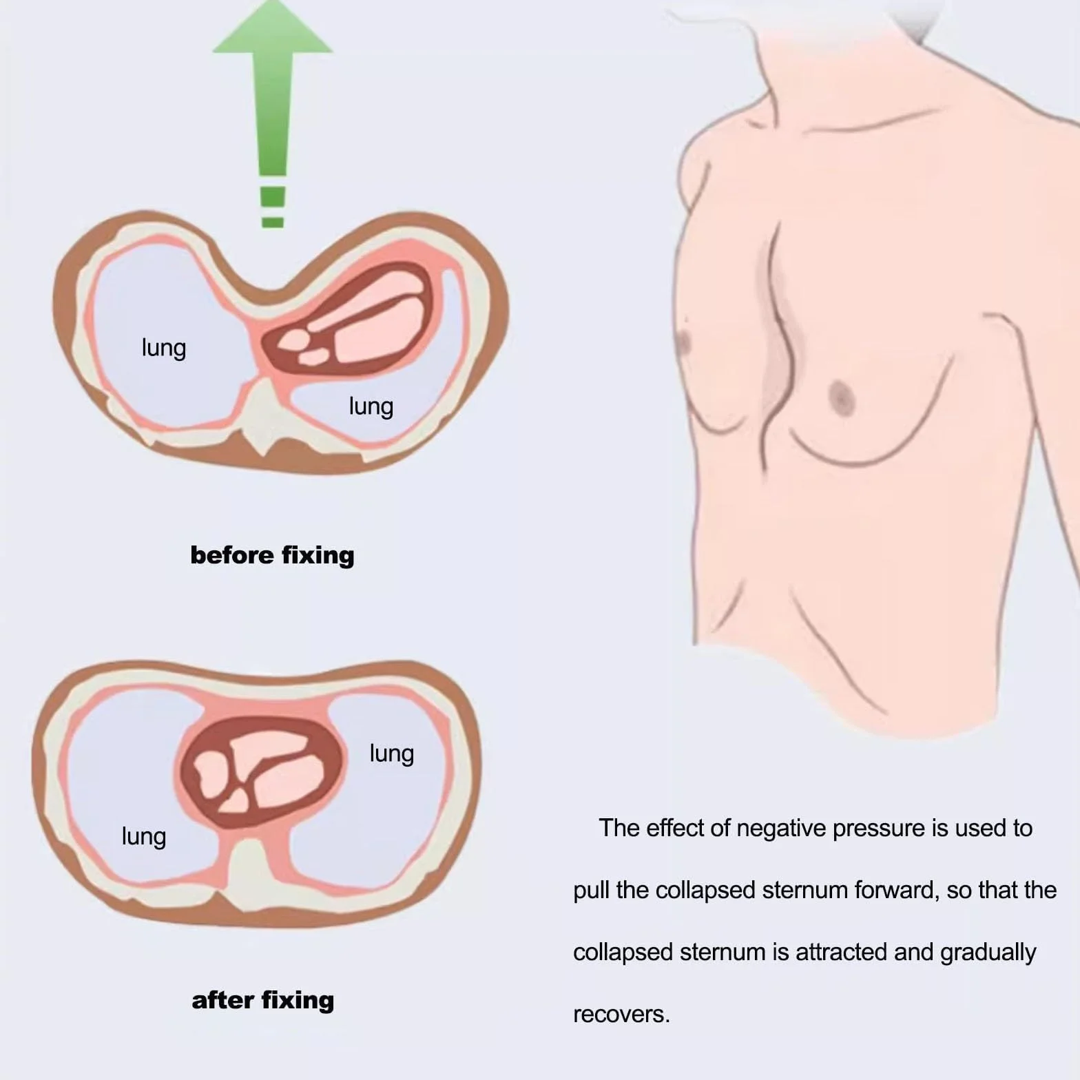 Pectus Excavatum Bańka próżniowa – Pectus Excavatum Orteza ortezy dla dorosłych i dzieci, fizyczna korekcja Pectus Excavatum, terapia bąbelkami próżniowymi (L-L)